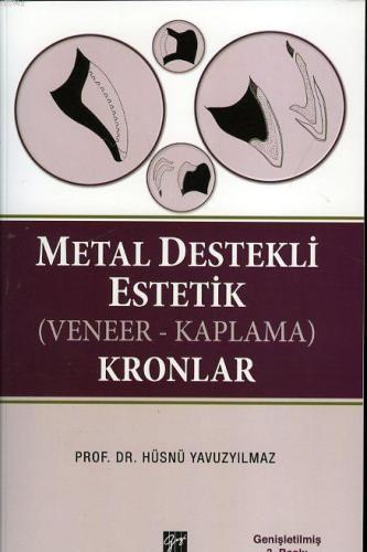 Metal Destekli Estetik (Veneer - Kaplama) Kronlar